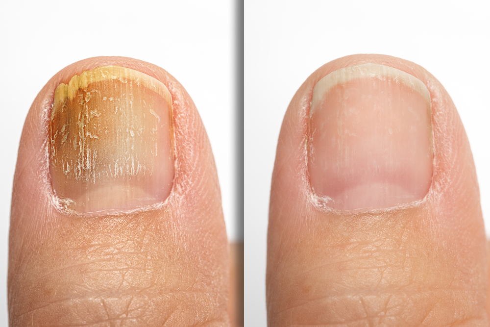 Nail Fungal before and after