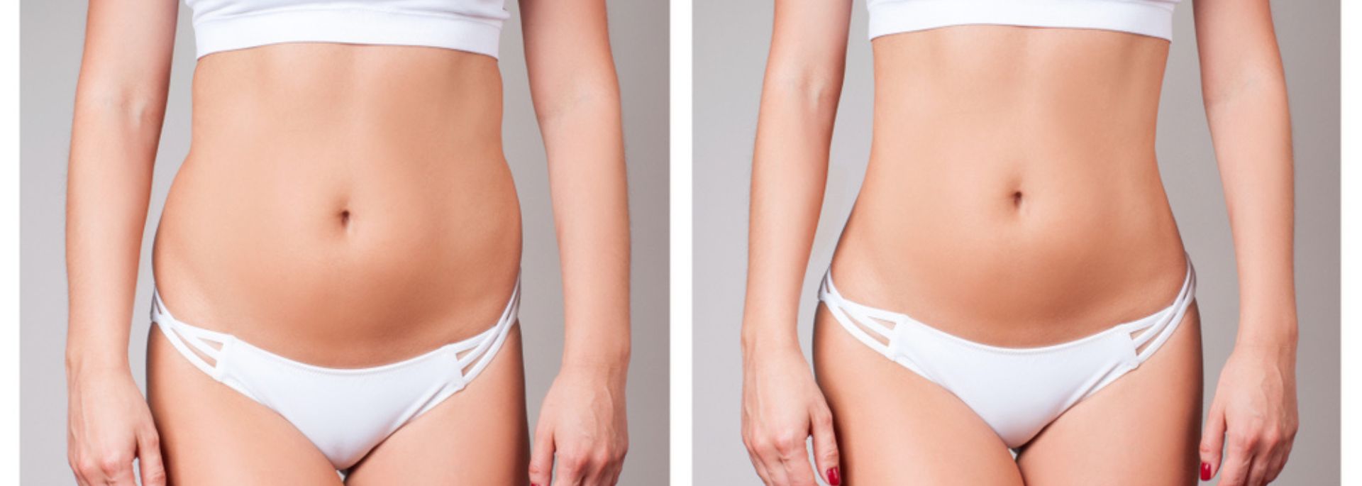 How Cryolipolysis Can Help Remove Stubborn Body Fat