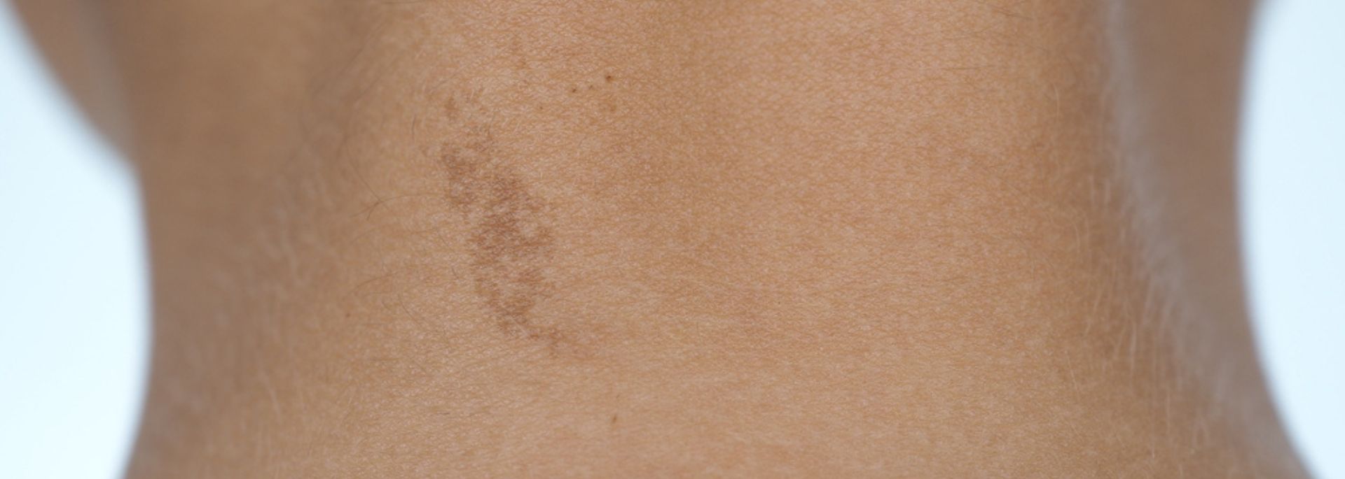 Cafe au lait birthmark on the back of a neck - How we remove cafe au lait birthmark