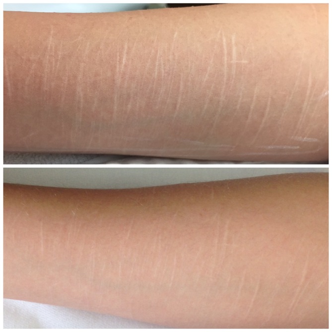 Self Harm Scars Treatment